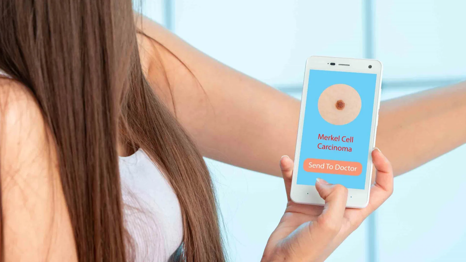 Cientistas descobrem medicamento imunológico que pode impedir a propagação fatal do câncer de pele